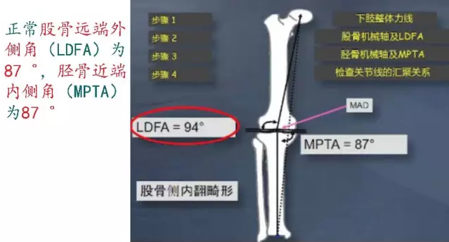 胫骨高位截骨术(HTO)治疗膝关节骨关节炎图片