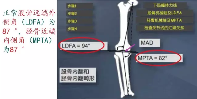 胫骨高位截骨术(HTO)治疗膝关节骨关节炎图片