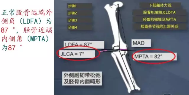 胫骨高位截骨术(HTO)治疗膝关节骨关节炎图片