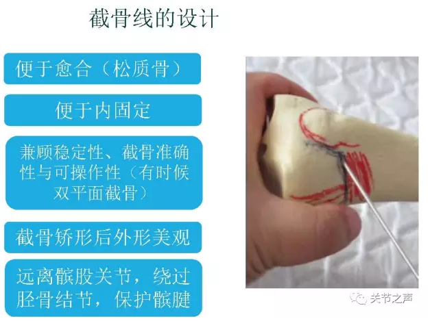 胫骨高位截骨术(HTO)治疗膝关节骨关节炎图片