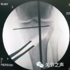 胫骨高位截骨术(HTO)治疗膝关节骨关节炎图片