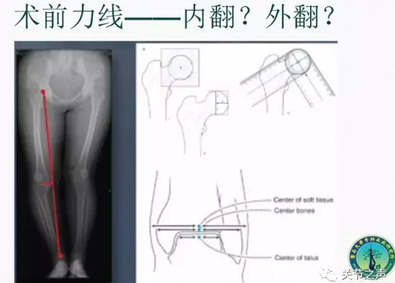 胫骨高位截骨术(HTO)治疗膝关节骨关节炎图片