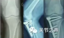 胫骨高位截骨术(HTO)治疗膝关节骨关节炎图片