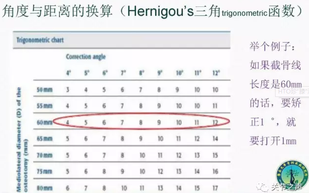 胫骨高位截骨术(HTO)治疗膝关节骨关节炎图片