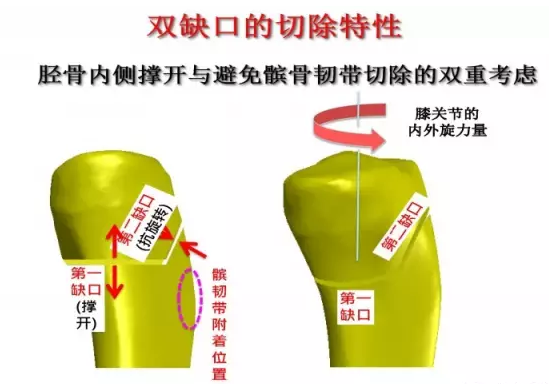 胫骨高位截骨术(HTO)治疗膝关节骨关节炎图片