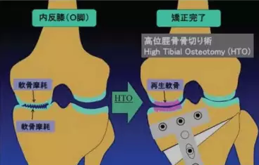 胫骨高位截骨术(HTO)治疗膝关节骨关节炎图片