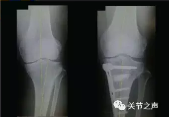 胫骨高位截骨术(HTO)治疗膝关节骨关节炎图片