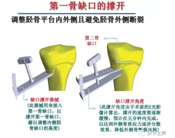胫骨高位截骨术(HTO)治疗膝关节骨关节炎图片