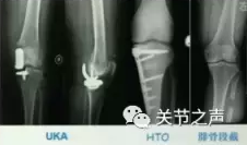 胫骨高位截骨术(HTO)治疗膝关节骨关节炎图片