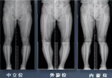 胫骨高位截骨术(HTO)治疗膝关节骨关节炎图片