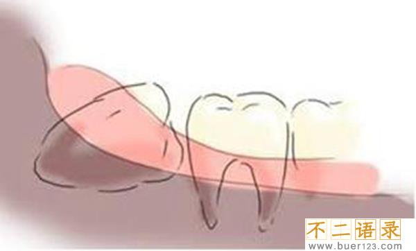 拔智齿后悔死了?这几种情况拔智齿会后悔(千万注意)图片