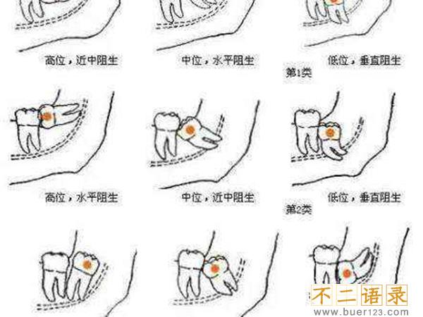 拔智齿后悔死了?这几种情况拔智齿会后悔(千万注意)图片