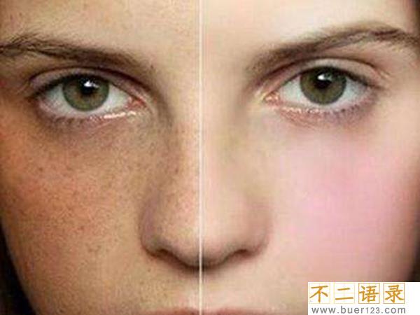 雀斑和黄褐斑有什么区别？如何简单分辨雀斑和黄褐斑图片