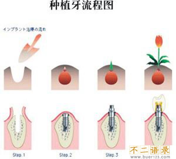良心医生不建议种植牙?种植牙有几大误区需要注意图片