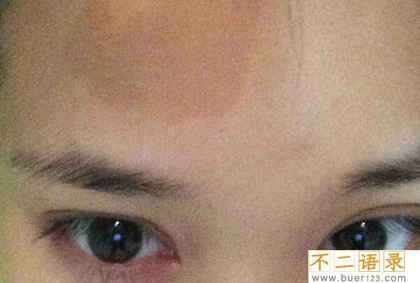 女人脸上有胎记好不好?要看胎记的位置才知道图片