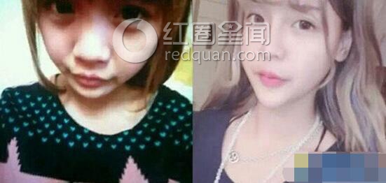 韩安冉整容前的样子 韩安冉取出下巴假体图片