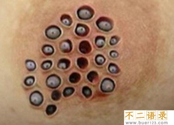 恶心的莲蓬乳是什么，莲蓬P在胸上/真实存在的病症(图片)图片