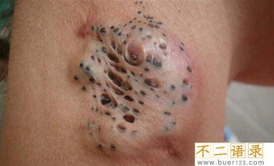 恶心的莲蓬乳是什么，莲蓬P在胸上/真实存在的病症(图片)图片