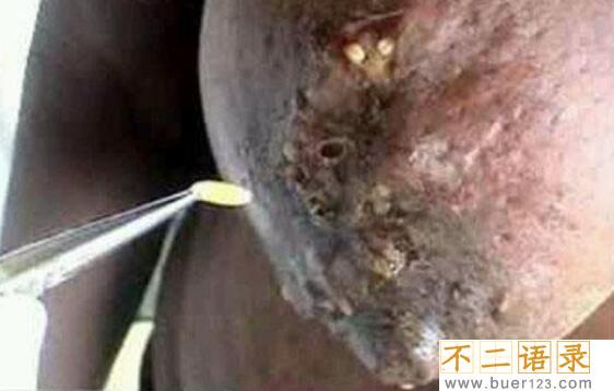 恶心的莲蓬乳是什么，莲蓬P在胸上/真实存在的病症(图片)图片