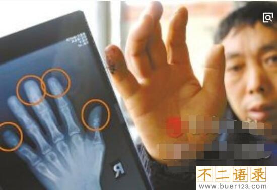 揭秘人体鬼怪骨之谜，世界罕见怪病(身体骨头被恶魔吃掉)图片