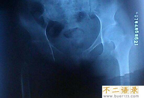 揭秘人体鬼怪骨之谜，世界罕见怪病(身体骨头被恶魔吃掉)图片