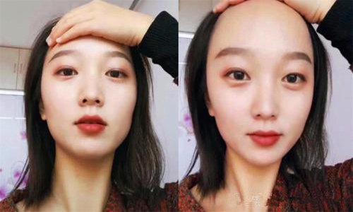 女生发际线过高怎么改善 小妙招教你补救你的发际线图片