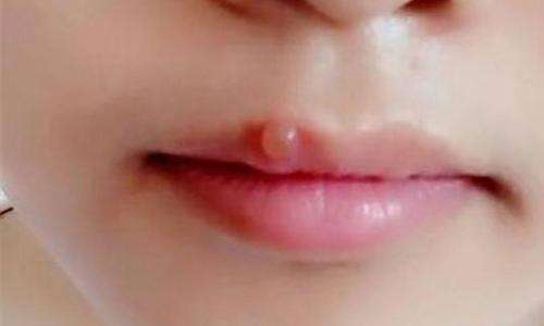 嘴唇上长水泡是什么原因？怎么治疗快速能消除？图片